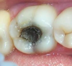 Проблемы с зубами при пульпите: методы лечения